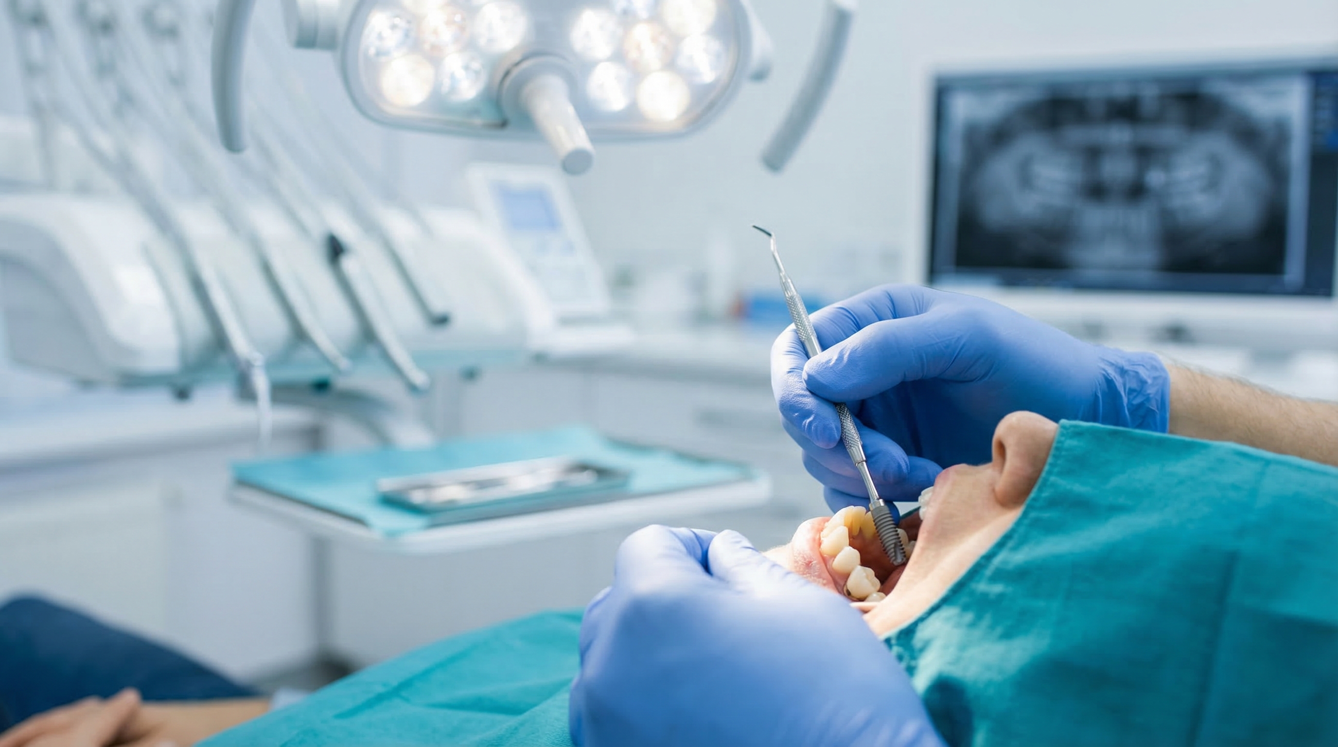 Implantes Dentários